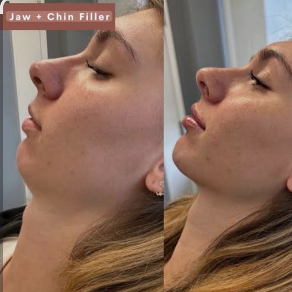 Jawline & Chin Filler at Boujee Asthetics ✨ in Tucson, AZ