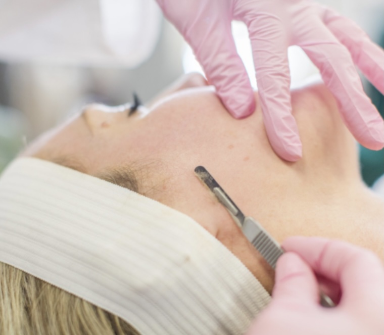 Dermaplaning