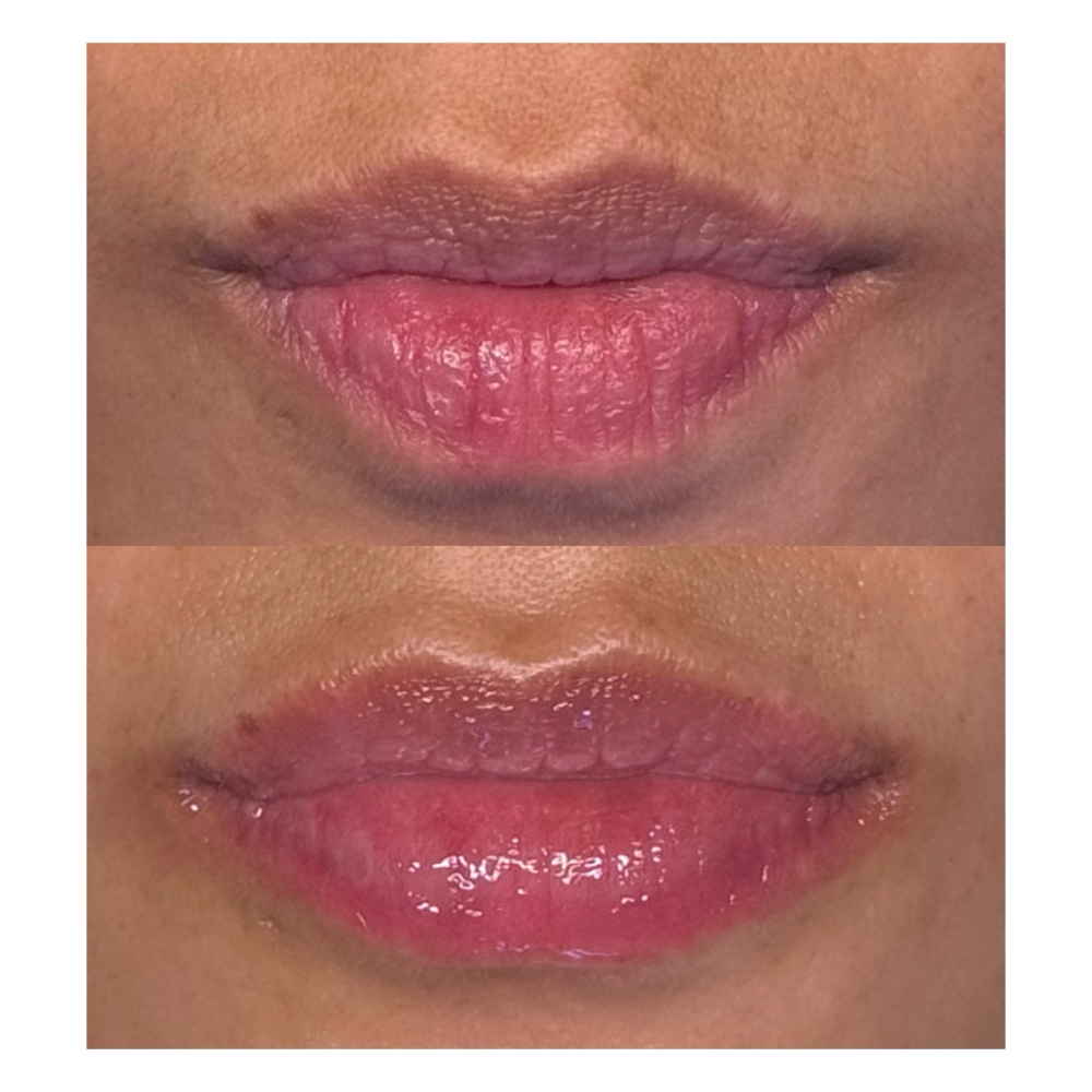 Lip Treatment