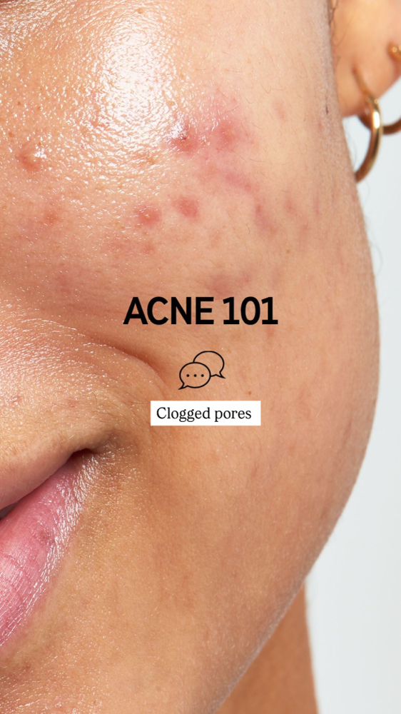 Acne Facial