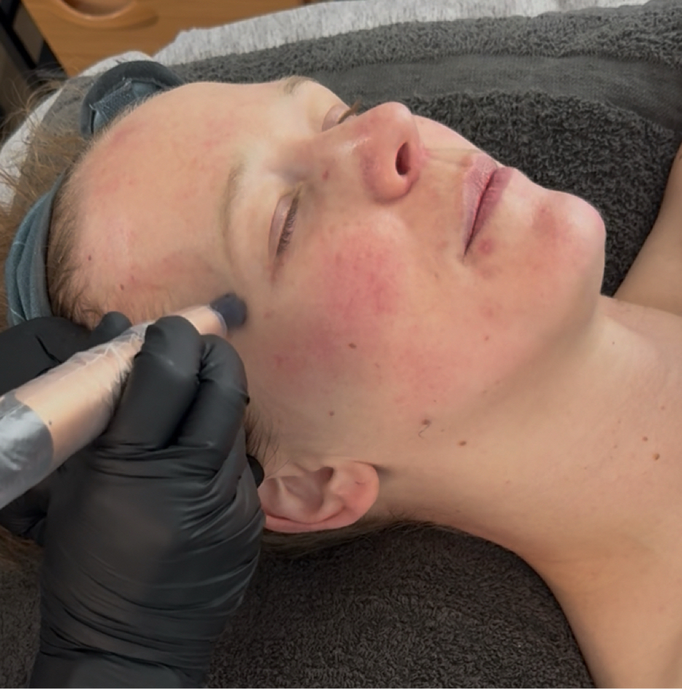 Microneedling at Desert Bloom Skin Studios in North Ogden, UT