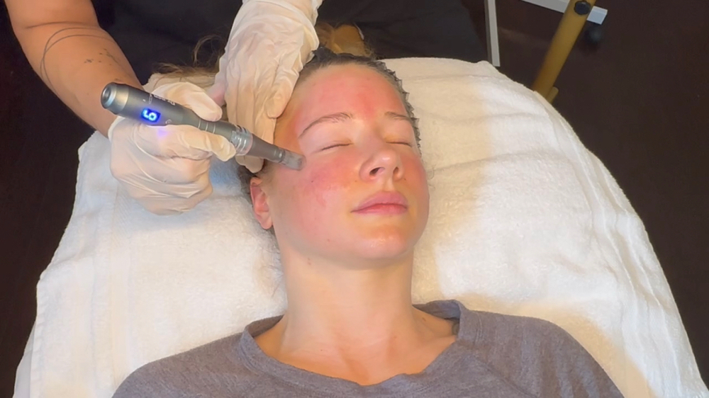 Microneedling at Aesthetic NP Marie in Portland, OR