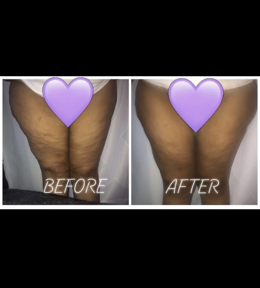 Thighs Cavitation