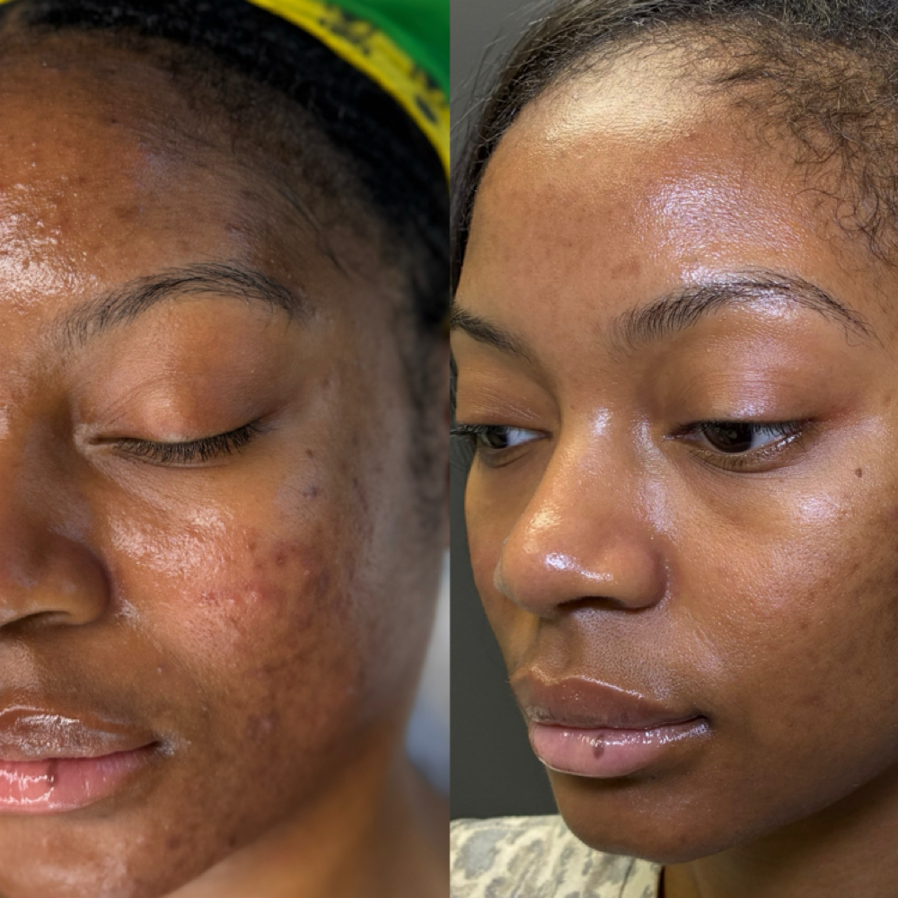 Microneedling Package 1 at Oasiah Aesthetics in New York, NY