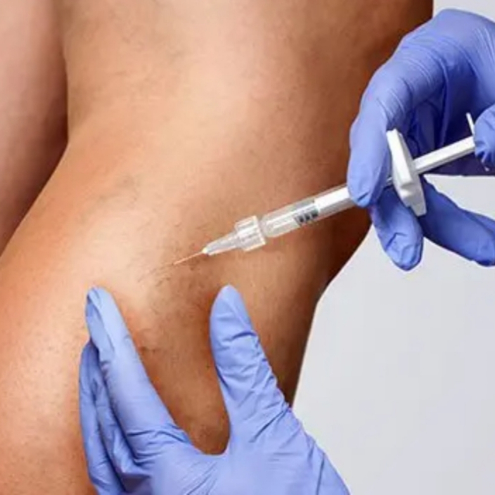 Sclerotherapy at BeautyGlo in San Antonio, TX