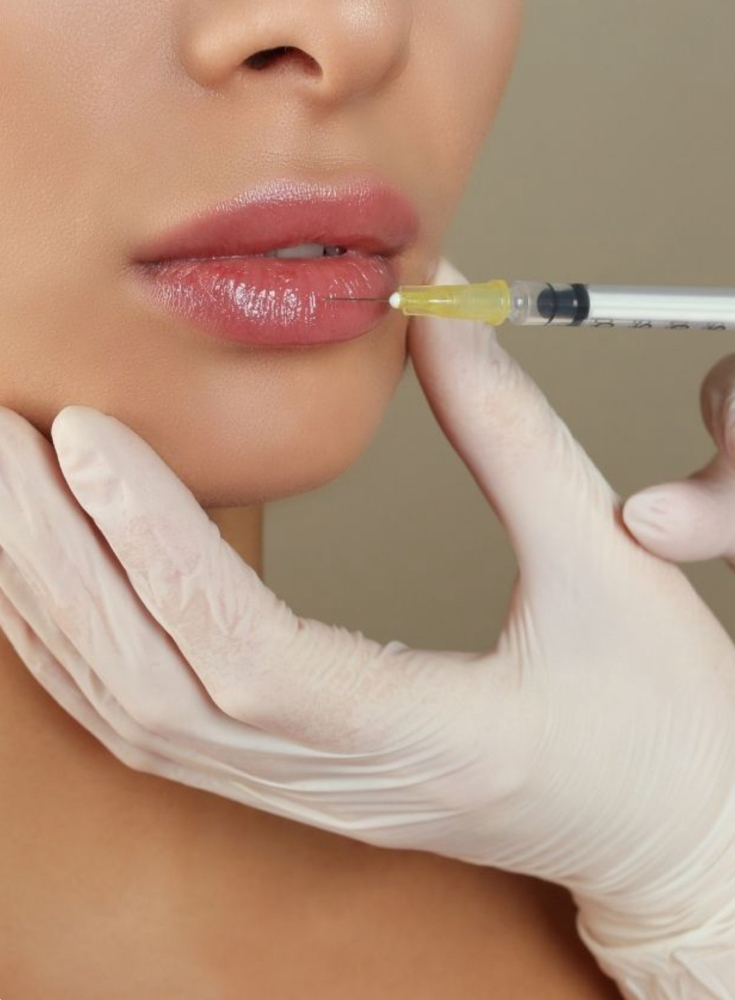 Lip Filler 1 Syringe