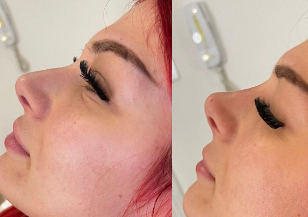 Nonsurgical Rinoplasty