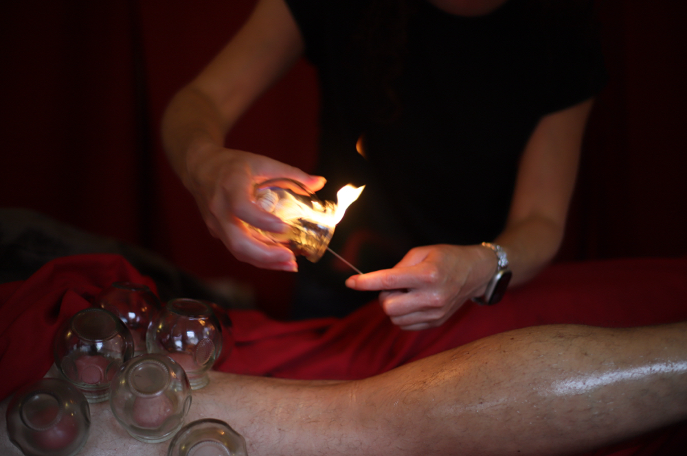 Fire (Dry) Cupping Session at Acupuncture North in Minneapolis, MN