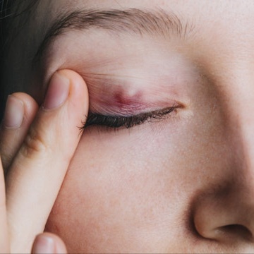 Chalazion IPL & LLLT Treatment at PRYSM LIGHT in West Burlington, IA