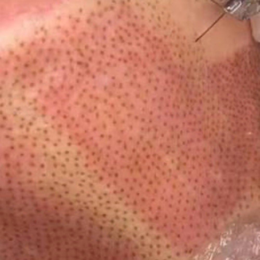 Plasma IQ Facial Restoration (F) at Empower Aesthetics in Canyon Lake, TX