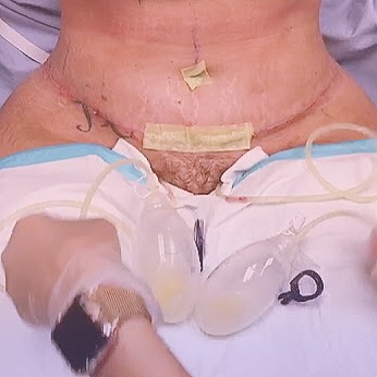 Tummy Tuck Drainage Removal