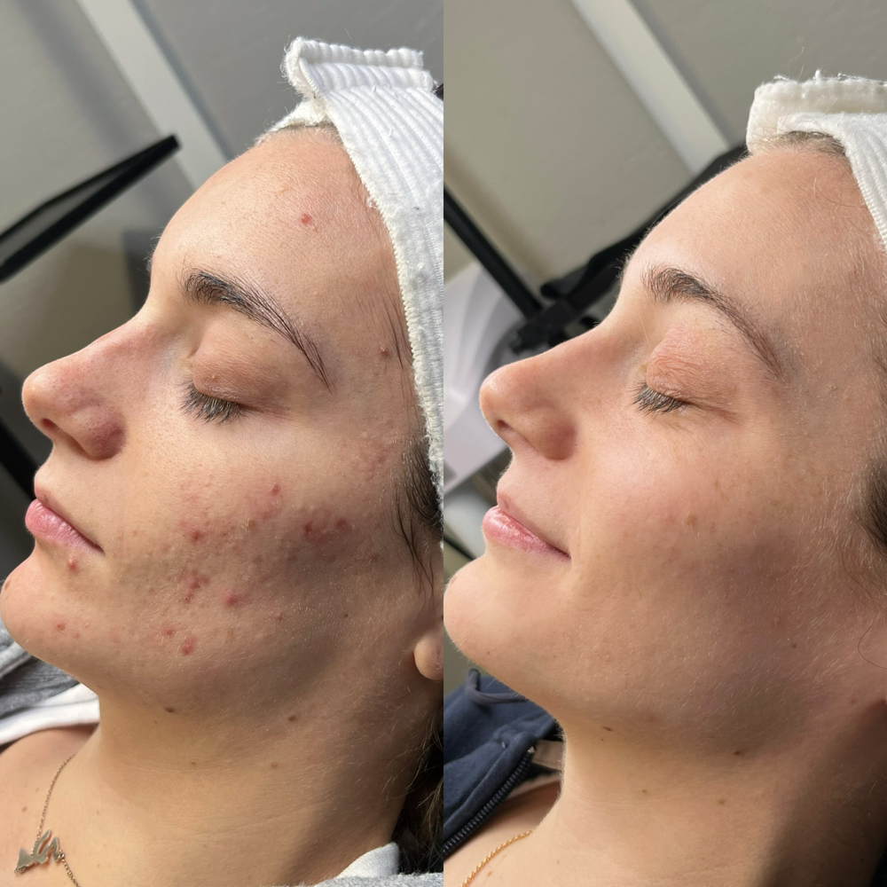 Acne Bootcamp Consult + Treatment