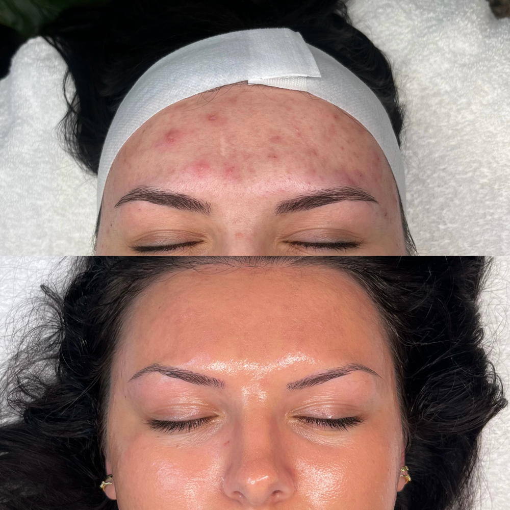 Acne Bootcamp Consult + Treatment at AC Skin and Beauty, LLC in Wyandotte, MI