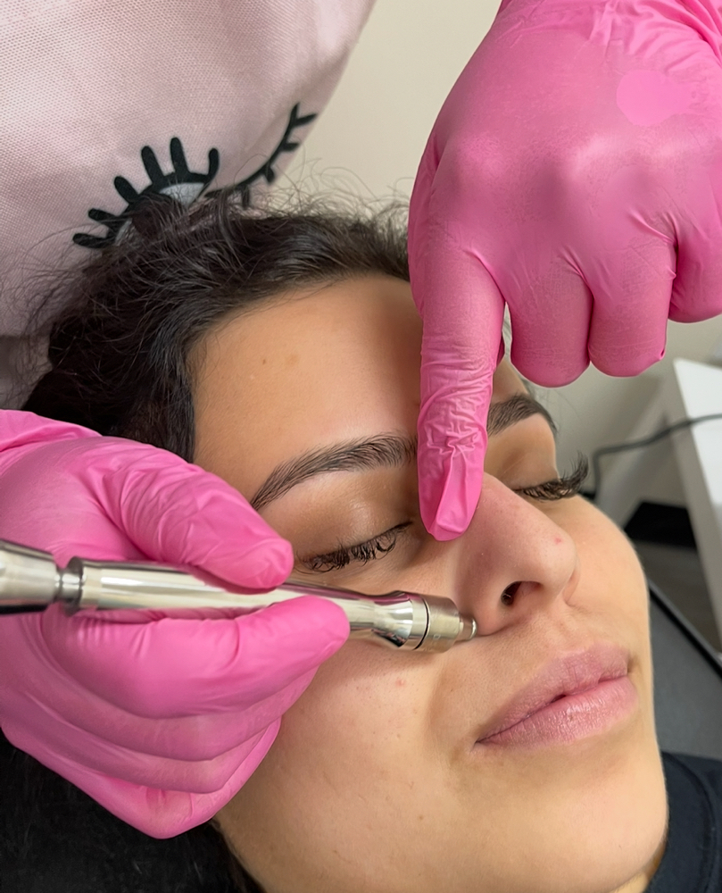 Microdermabrasion; Click For Option