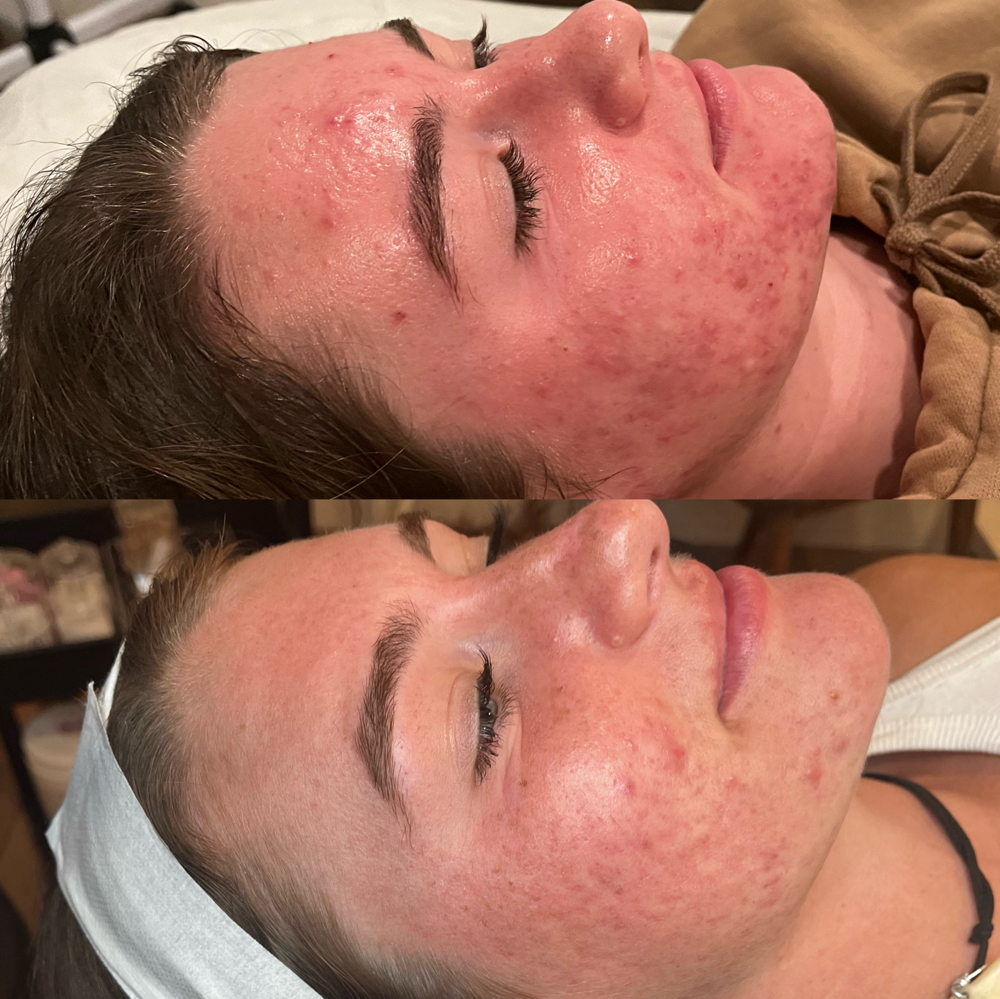 Acne Chemical Peel 🤍
