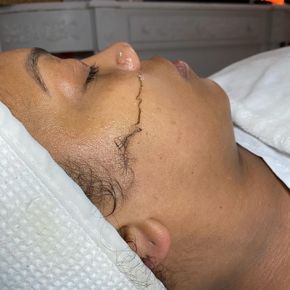 Dermaplaning Treatment