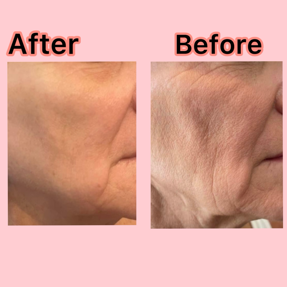 6 Cryo-Lean Facelift Sessions