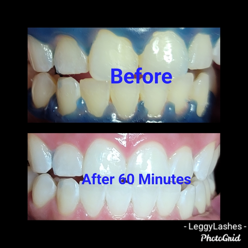 60 Minute Zoom Teeth Whitening