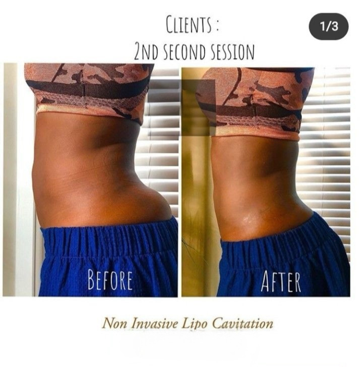 Cavitation Front & Back