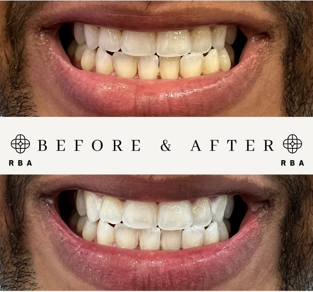 Teeth Whitening