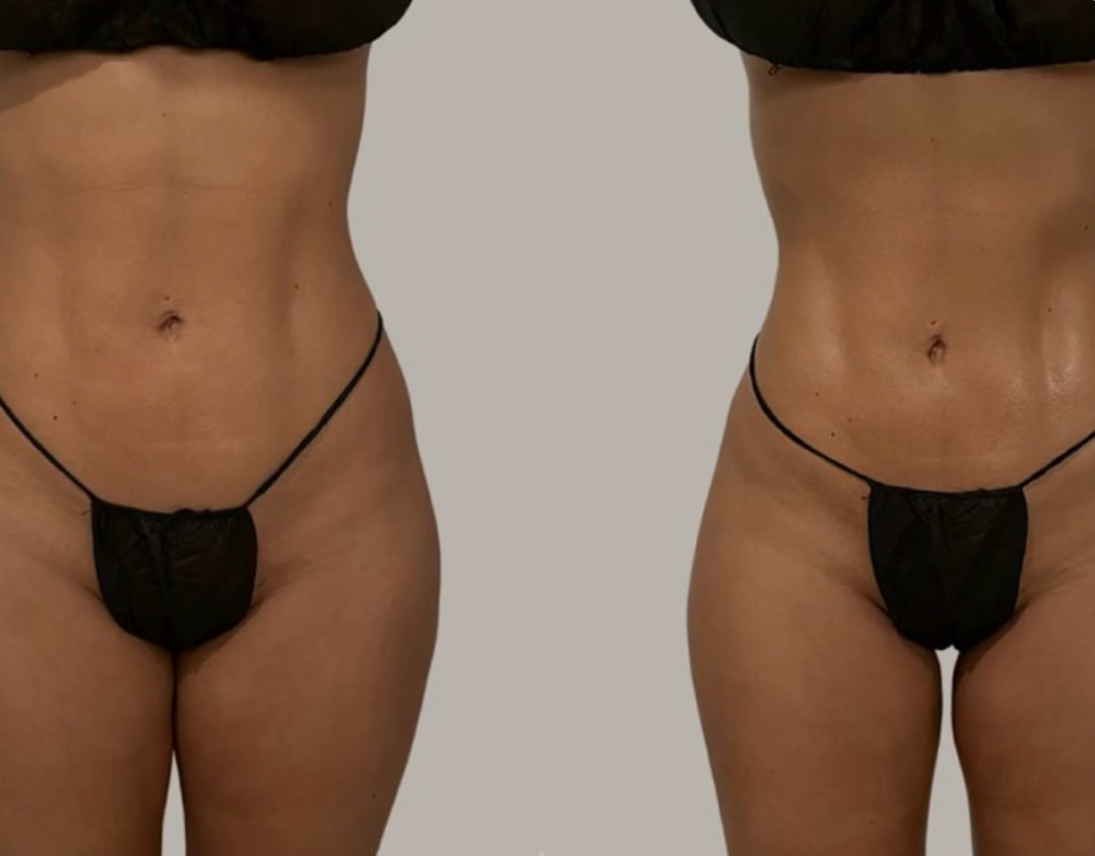 BRAZILIAN LYMPHATIC DRAINAGE at Nishati Wellness in Kennewick, WA