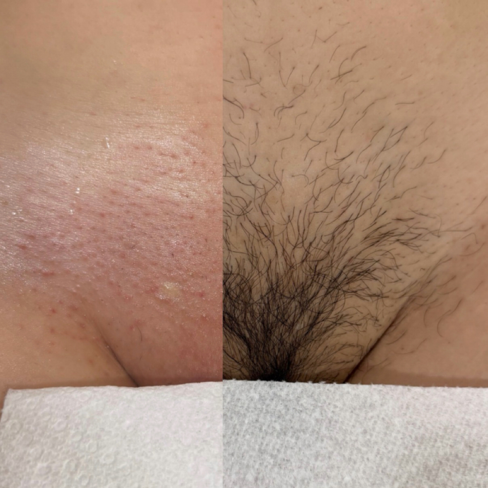 Brazilian (Female Anatomy) at CON AMOR ESTHETICS in Los Angeles, CA