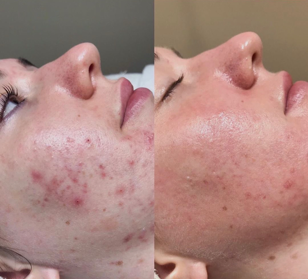 ACNE FACIAL