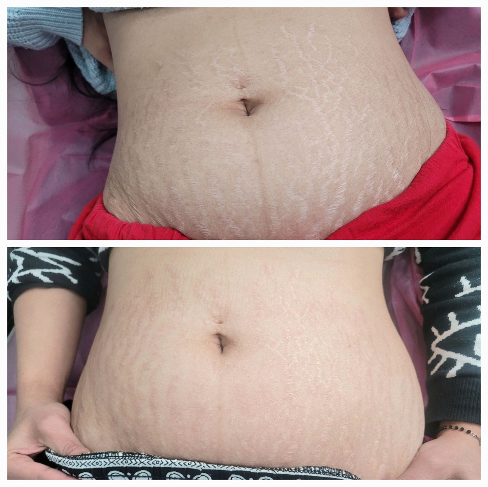 Inkless Stretch Mark Revision