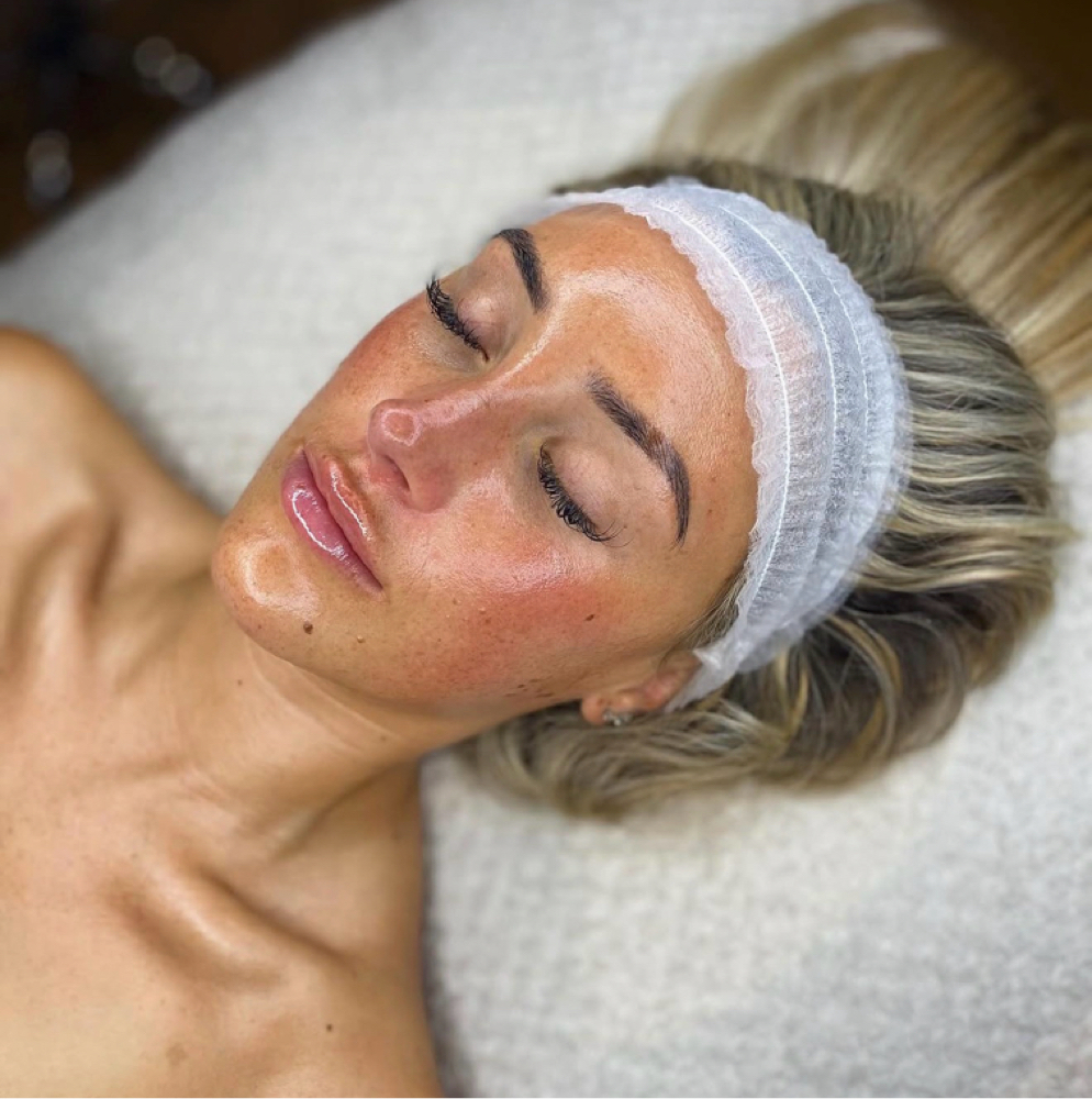 Acne Facial at Serenity Aesthetics in Sarasota, FL