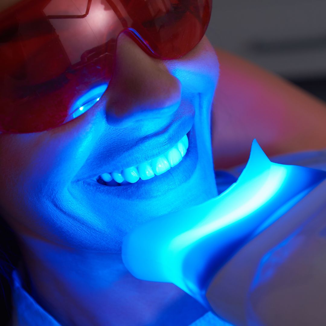 Moderate Teeth Whitening