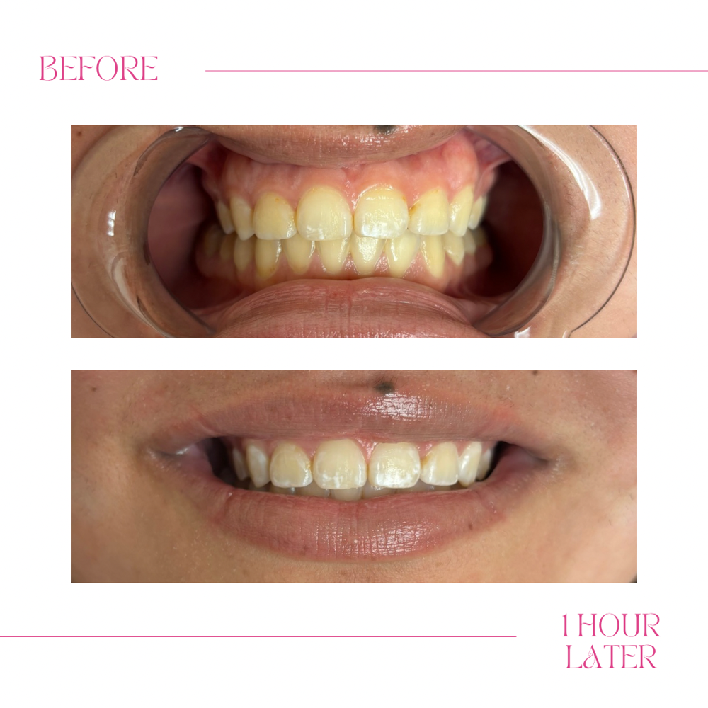 60 Minute Teeth Whitening
