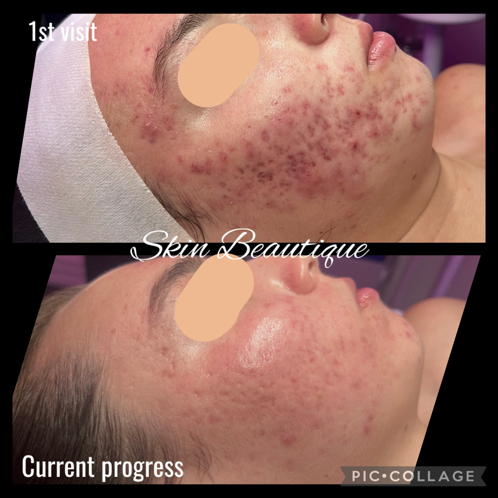 Face Reality Acne Bootcamp