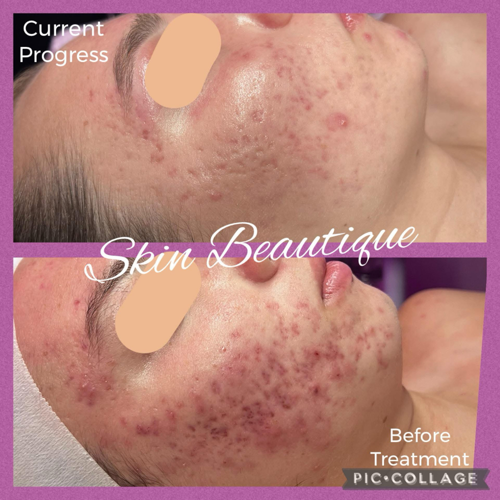 Face Reality Acne Bootcamp