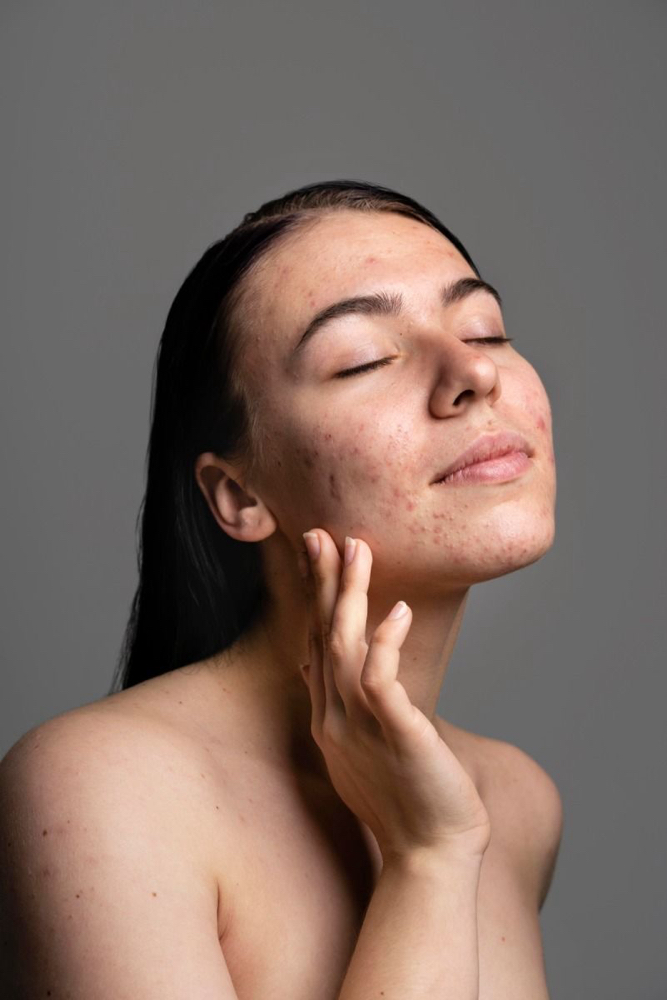 Acné Facial