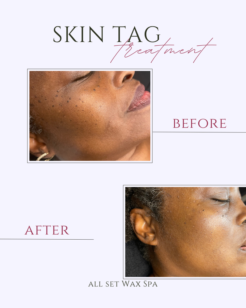 DPN Skin Tag Removal 1-5