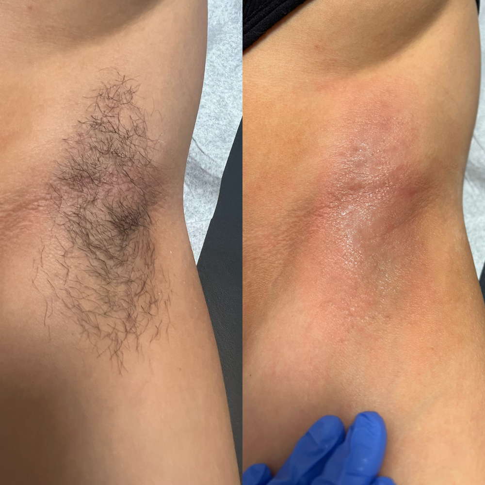 Underarm at Waxing By Kaleigh in Bossier City, LA