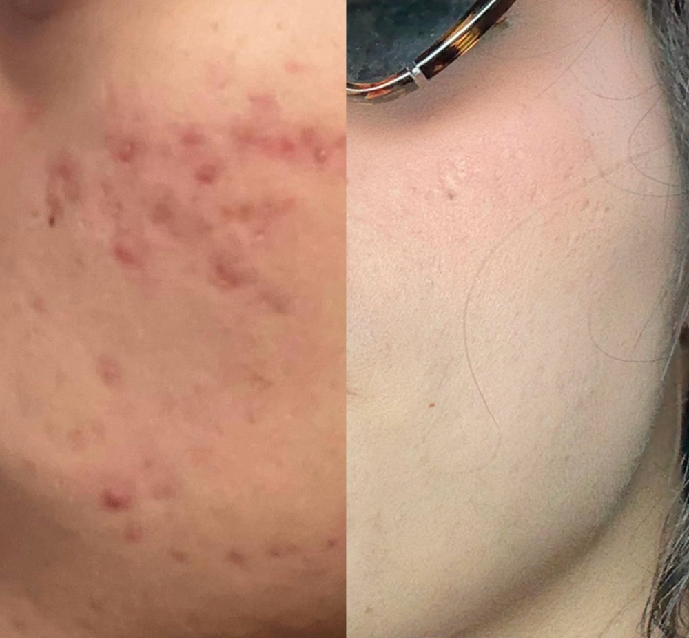 Chemical peels