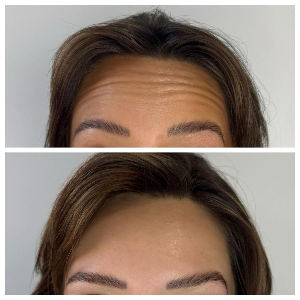 Botox for Forehead Lines at La Belle Aesthetics & Wellness in Hellertown, PA