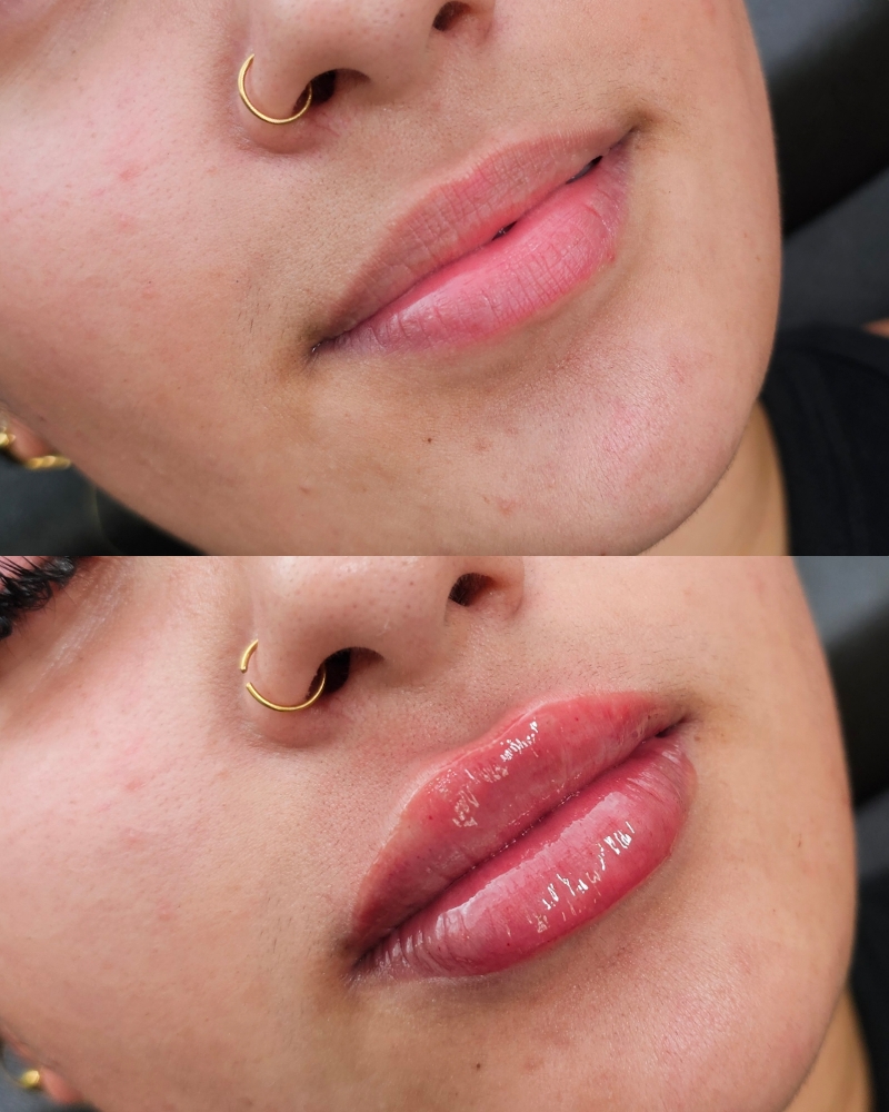 HA Lip Filler 2-3 week Touch Up