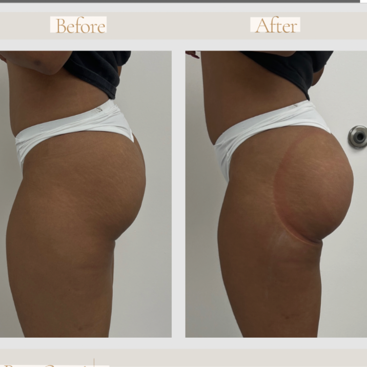 Butt Lift Vacuum Therapy at Glo'Up Body Spa in Atlanta, GA