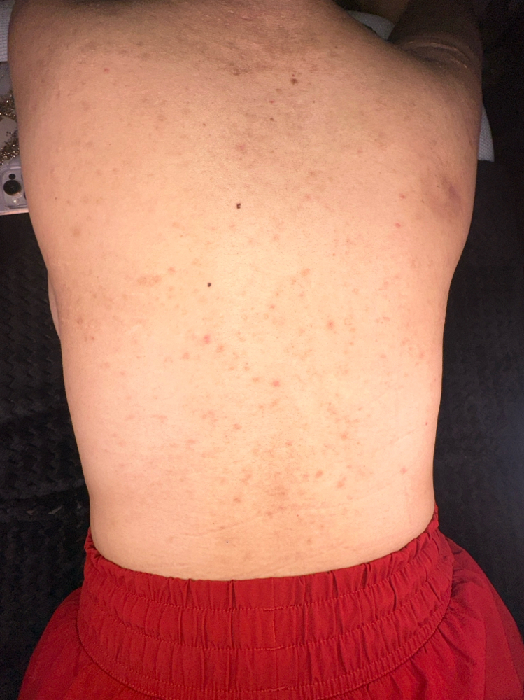 Back Hydrafacial