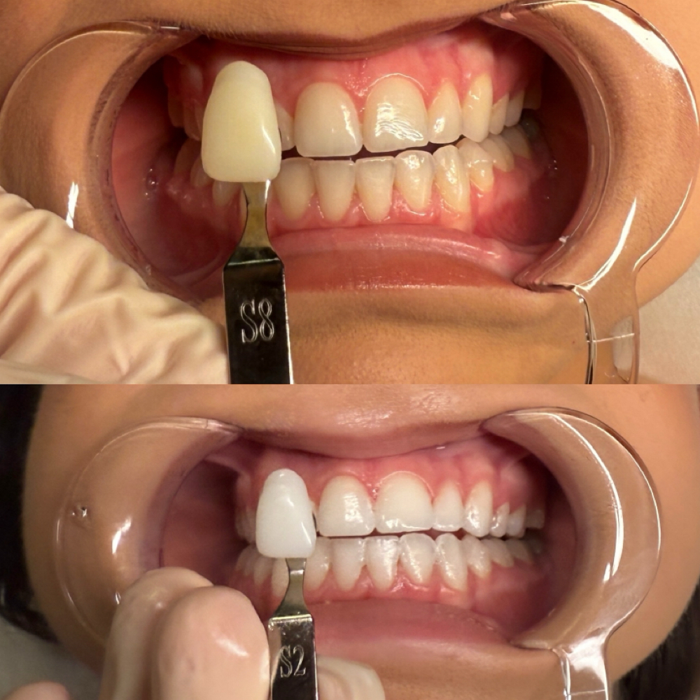 Teeth Whitening Express at MySkin Aesthetics in Laredo, TX