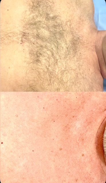 Chest Wax