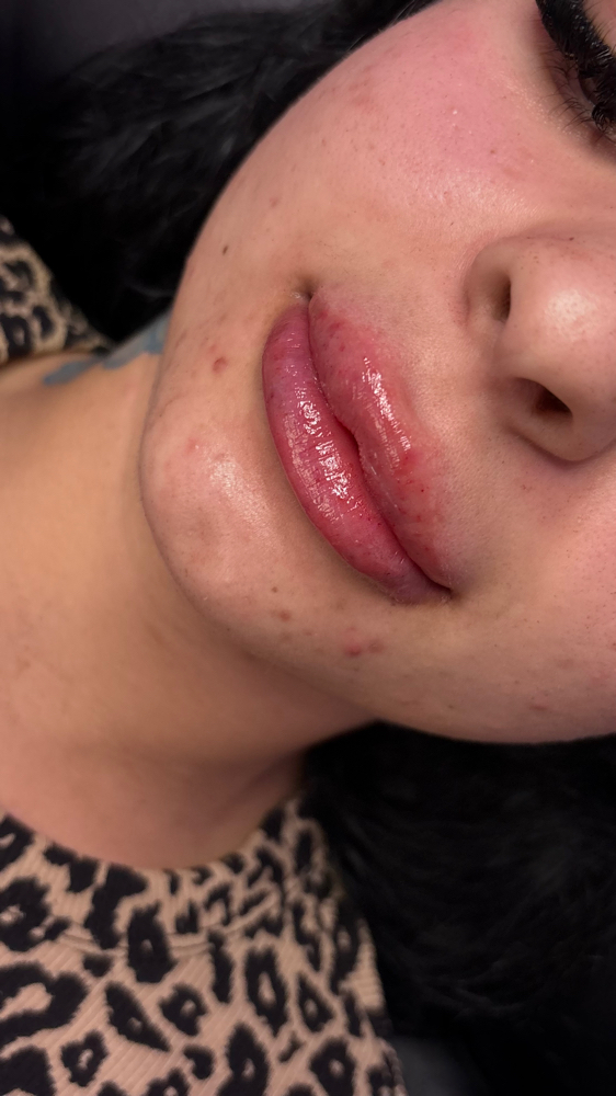 2ml Hyaluronic Acid Fillers