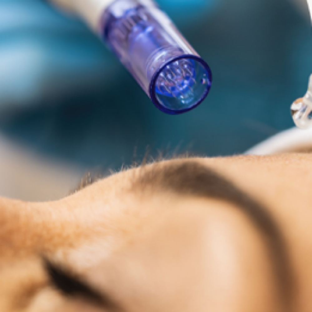 Microneedling at The Skin Suite in Littleton, CO