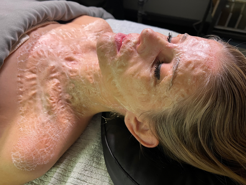 SKIN REVISION TREATMENT at Bliss Skin by Sam LLC in Lafayette, IN