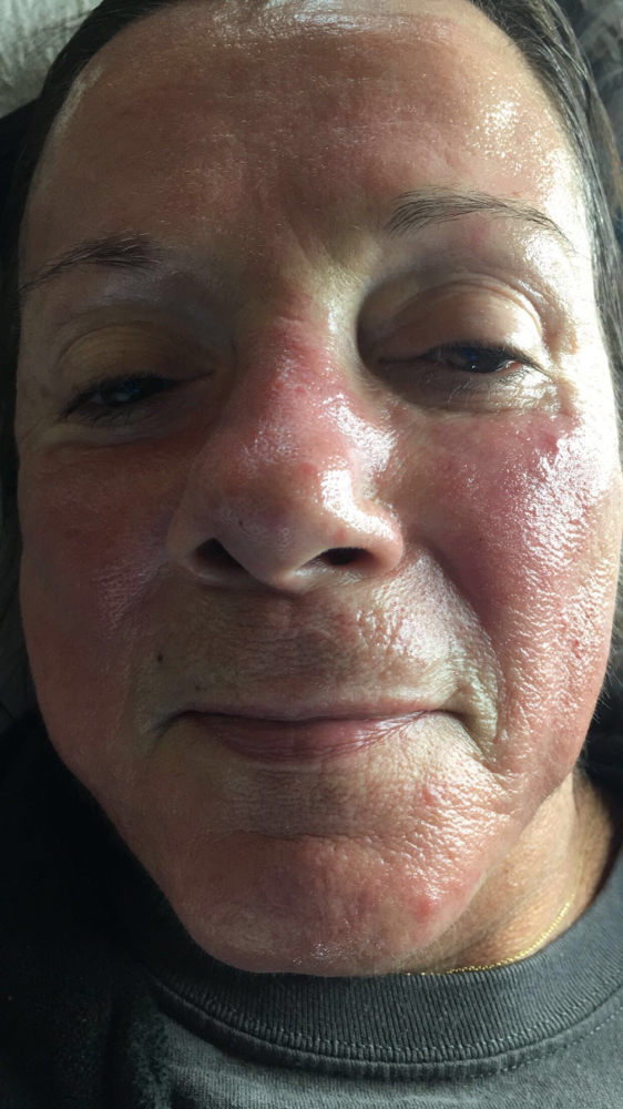 Micro Needling Facial