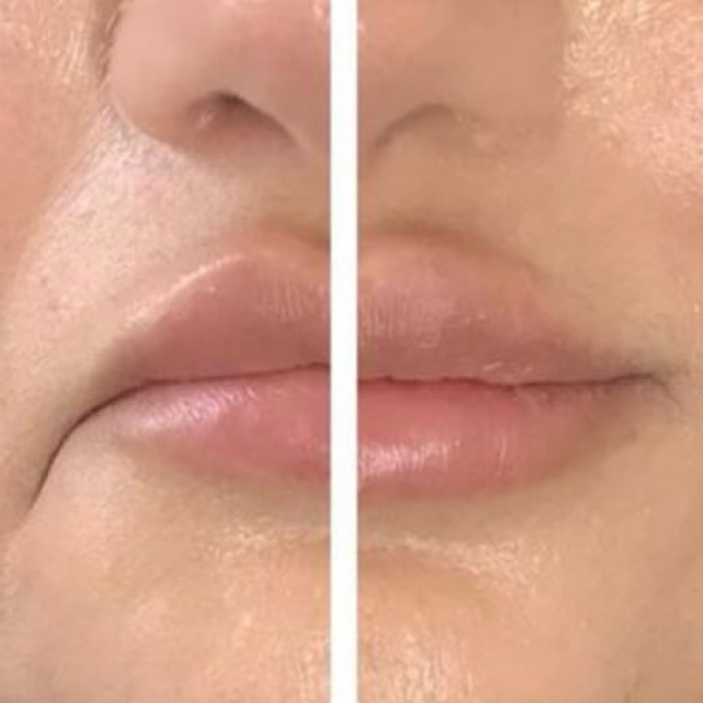 DAO Injection at Precision Aesthetics LLC in Harrodsburg, KY
