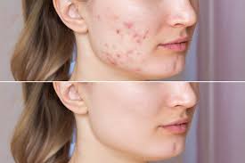 Boot Camp Bi-weekly Facials