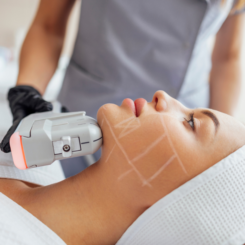 Ultherapy Face Lifting